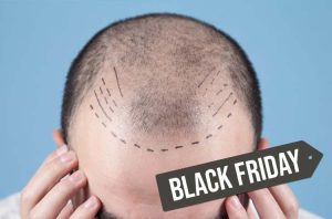 Workshop Prático de TRANSPLANTE CAPILAR