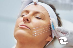 Curso de Rejuvenescimento Facial com Fios