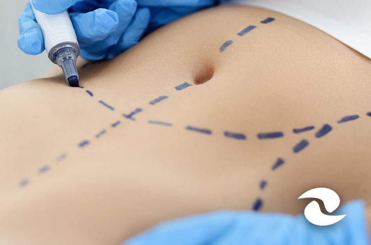 Curso de Lipoplastia de Fournier